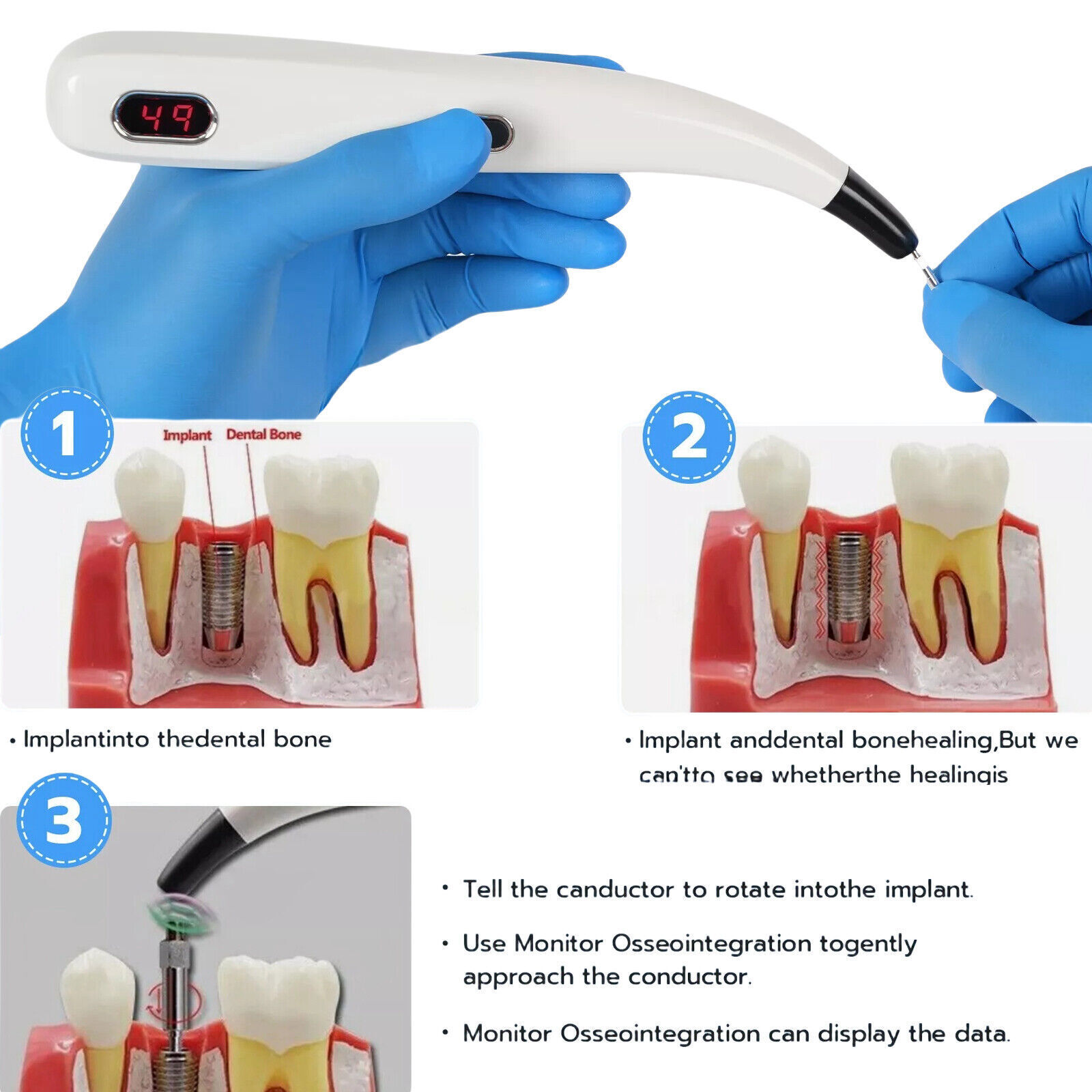 Dental Implant Stability Meter Implant Abutment Stability Measurement Tester