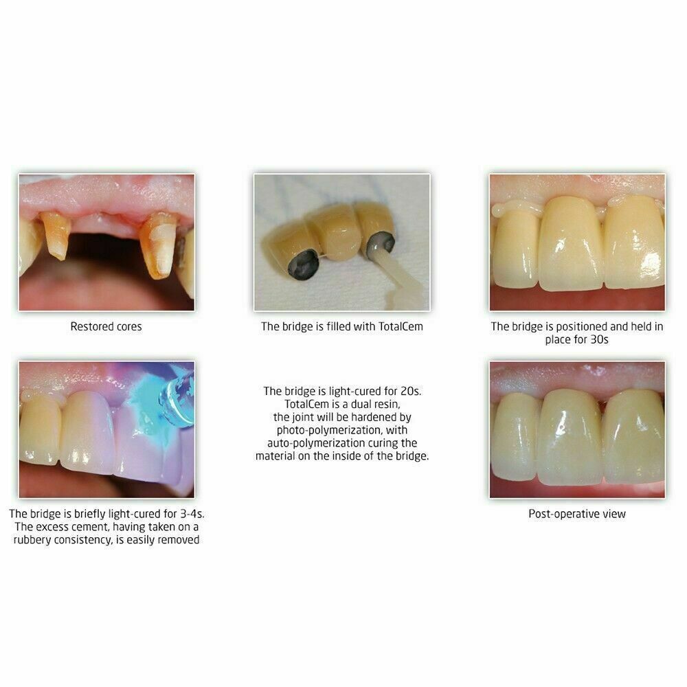 Dengen Dent Resin Clear Shade Cement New Pack Dental Material Lowest Price