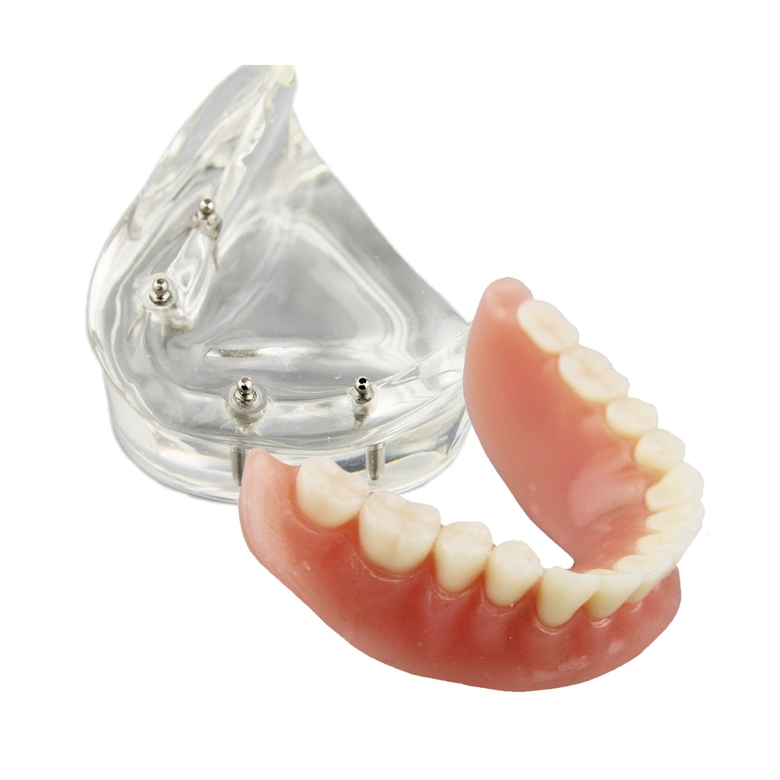 Dental Model Overdenture Inferior 4 Implants Demo for Teaching and Studying