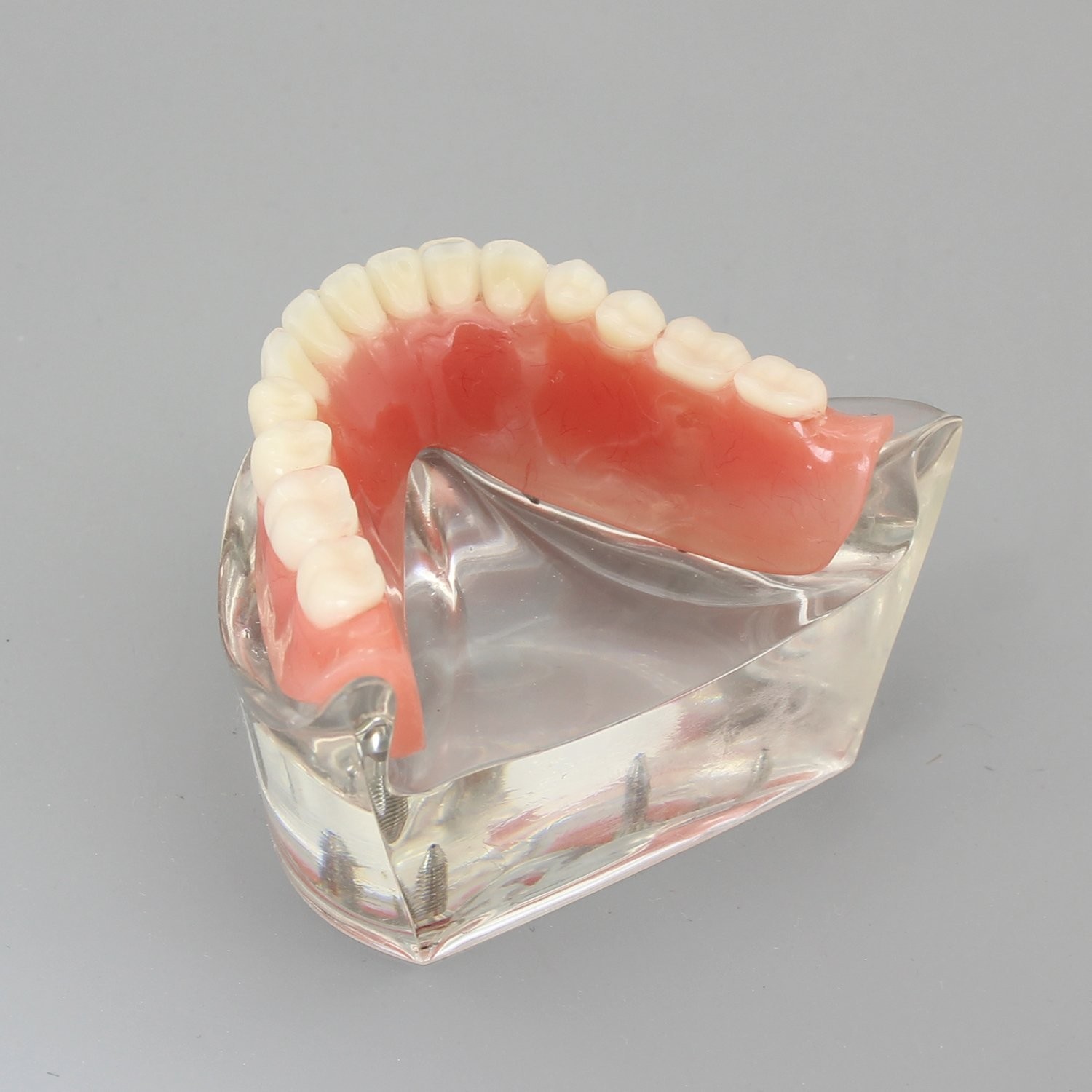 Dental Model Overdenture Inferior 4 Implants Demo for Teaching and Studying