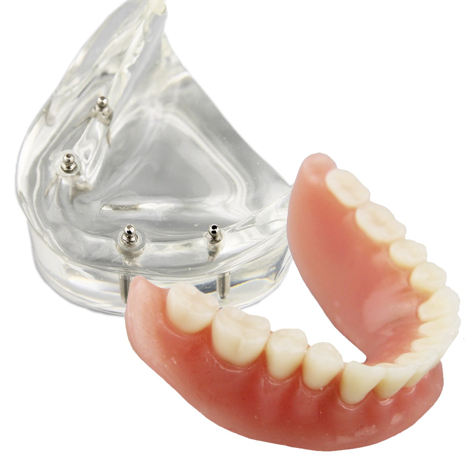 Smile1000 Dental Model Overdenture Inferior 4 Implants Demo for Teaching and …
