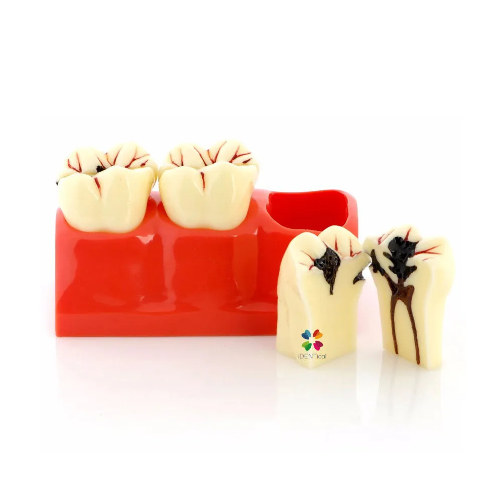 iDENTical Caries Development Tooth Model M4020 4 Times large caries tooth model