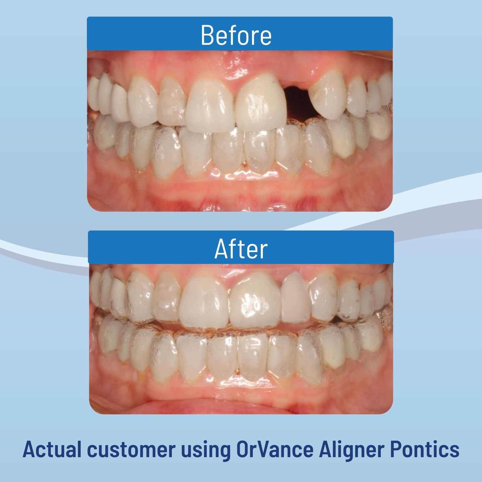 Aligner Pontics – (Medium) Shade (32 Count) | Temporary Tooth Replacement