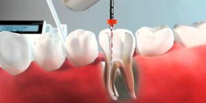 instrumentación mecanizada en endodoncia
